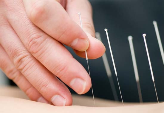 Châm cứu là một phương pháp điều trị hiệu quả cau tai biến